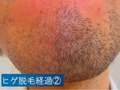 ヒゲ脱毛経過２