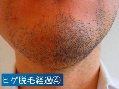 ヒゲ脱毛経過４