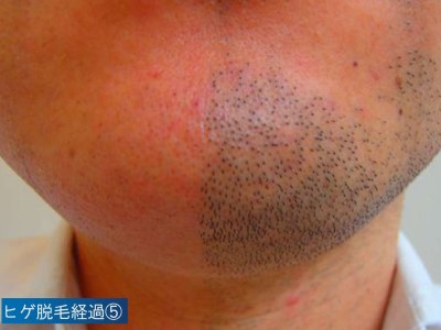 ヒゲ脱毛経過５