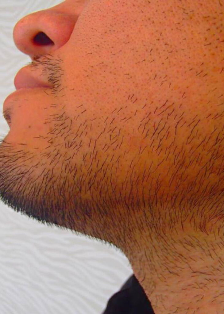 デザイン脱毛before