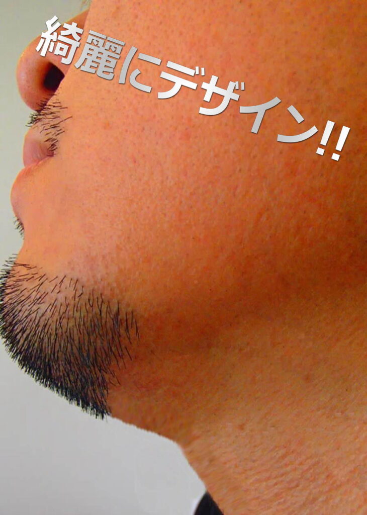 デザイン脱毛後