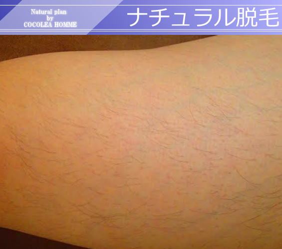 ナチュラル脱毛1