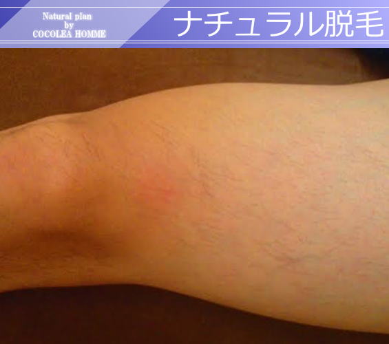 ナチュラル脱毛2