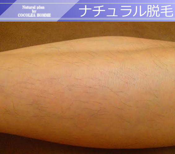 ナチュラル脱毛3