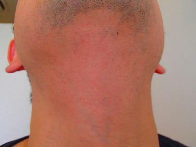 あご下 首脱毛後