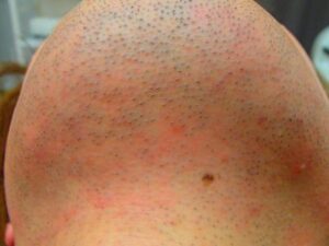 あご下　脱毛前