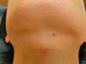 あご下　脱毛後