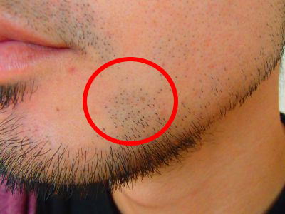 あごヒゲ　デザイン脱毛前