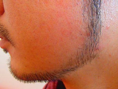 あごヒゲ ほほ デザイン脱毛後