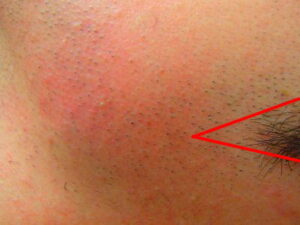 もみあげ デザイン脱毛前