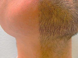 あご 首 脱毛 アップ