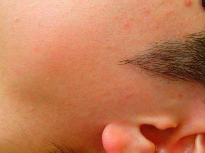 もみあげ デザイン脱毛後