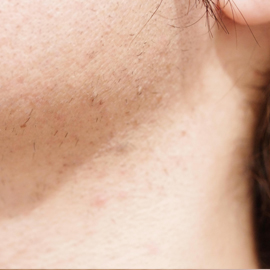 ひげ もみあげ 首 施術後