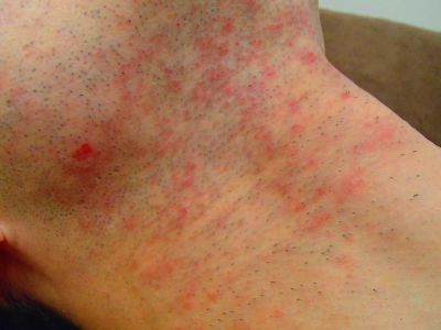 ヒゲ脱毛前(肌荒れ)