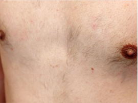 胸 1回目施術後