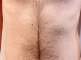 K様 おなか 施術前