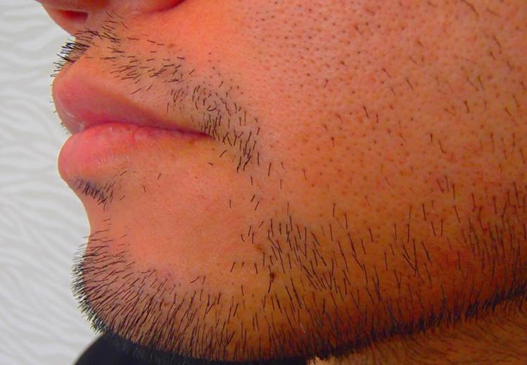 あご頬もみあげデザインひげ施術前