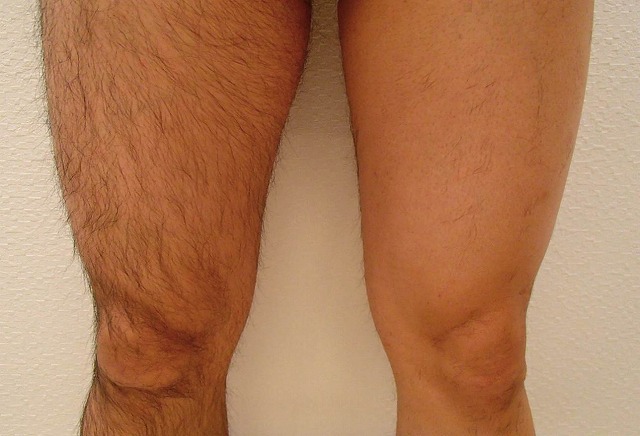 太もも 施術1回(左足)