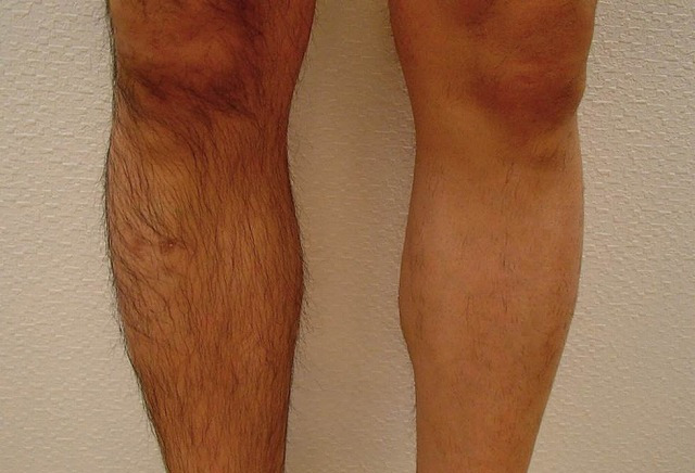 ひざ下施術1回（左足）