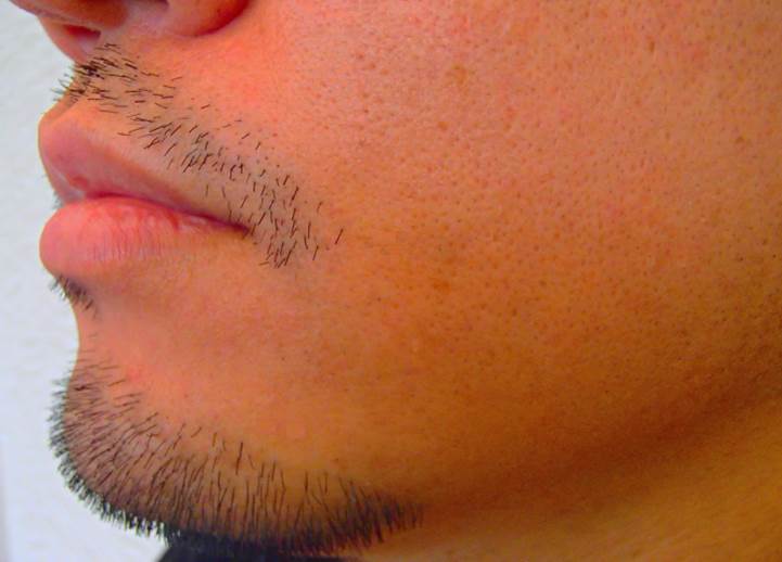 あご頬もみあげデザインひげ施術後