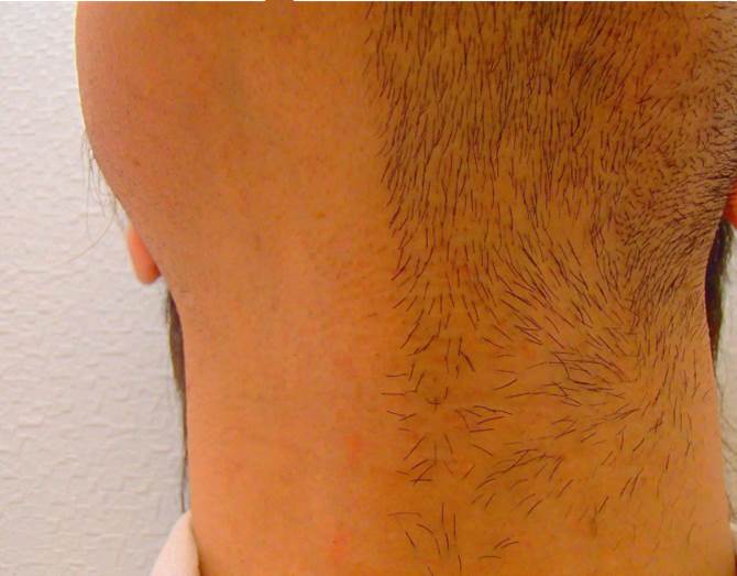 あご下　首半分　脱毛