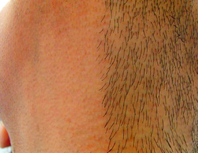 あご下　首半分　脱毛　アップ