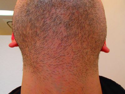 あご下　首脱毛前