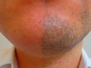 あごひげ脱毛効果